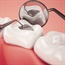 Are your dental fillings causing tooth decay?