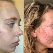 Since accepting her cystic acne, woman becomes the face of skincare brand embracing real skin