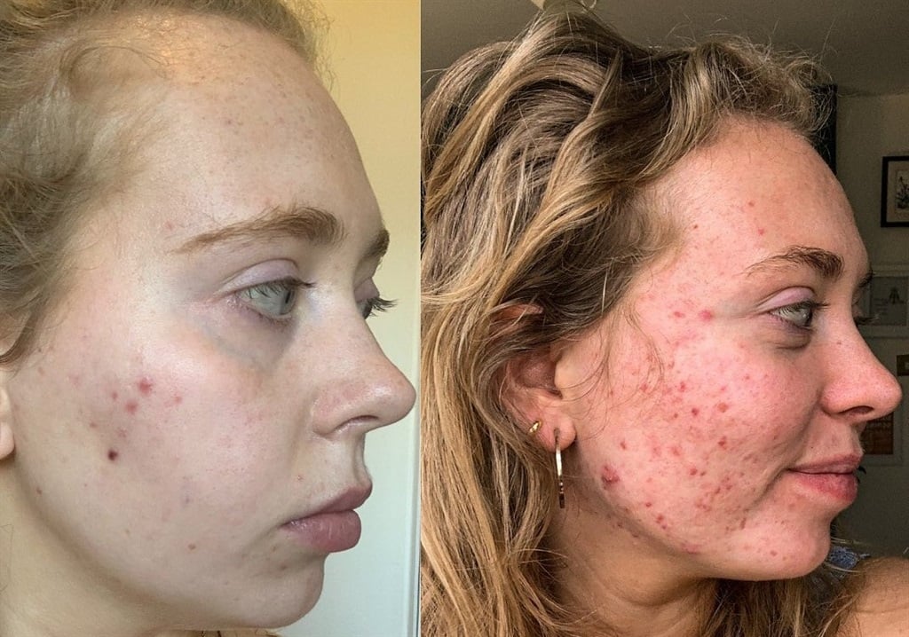 Since accepting her cystic acne, woman becomes the face of skincare brand embracing real skin