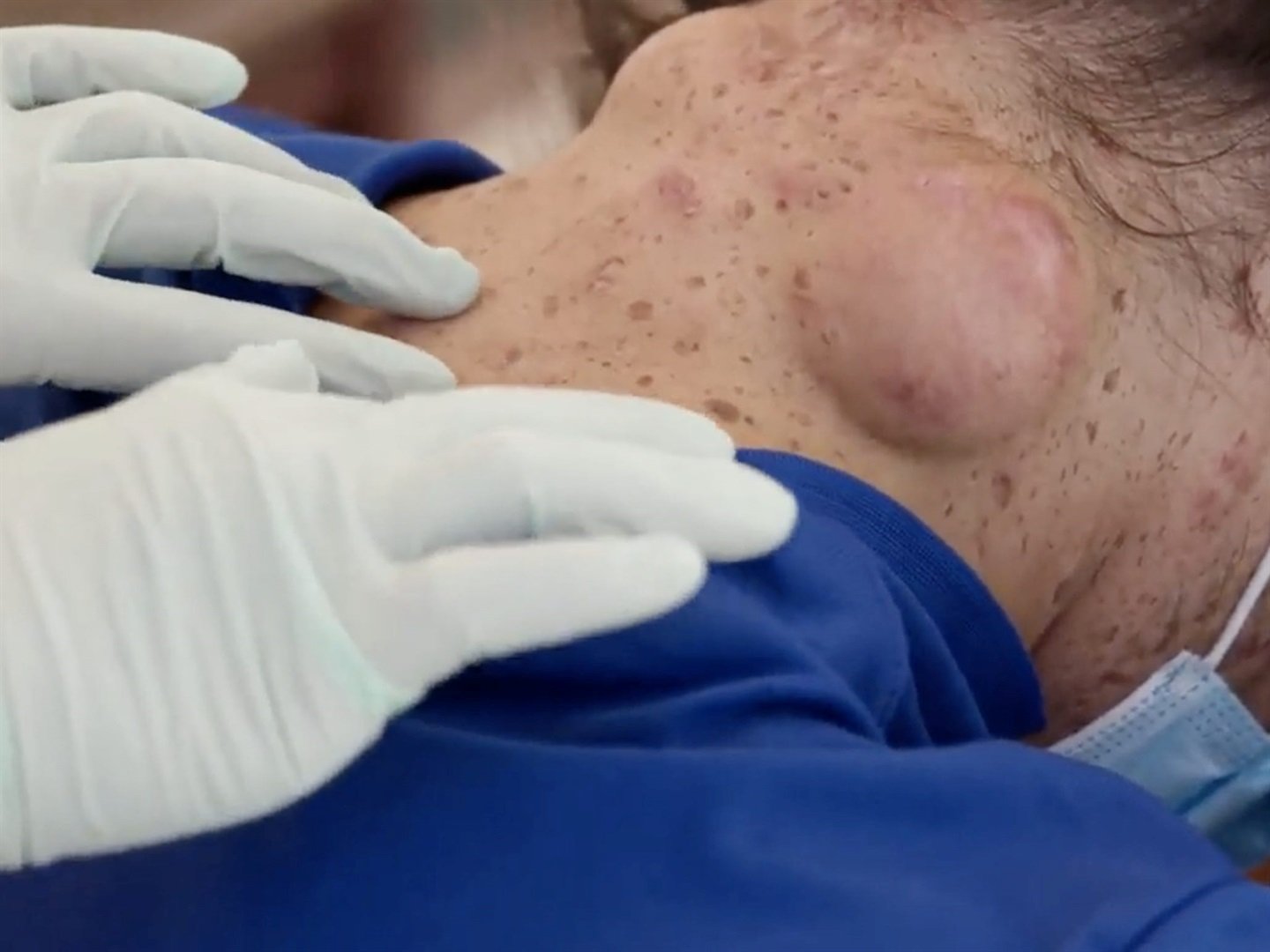 Dr Pimple Popper squeezed man's 3 swollen 'mashed potato' neck cysts to