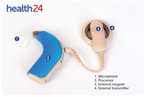 cochlear implant, graphic, hearing, hearing loss