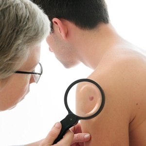 Learn to spot the early signs of skin cancer. (iStock)