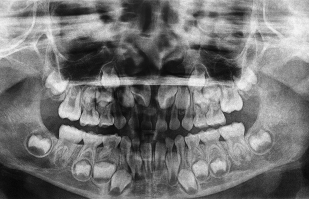 Xray of a child's mouth