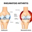 Risks of rheumatoid arthritis