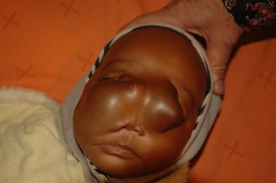 Namibian baby to have rare surgery in SA | Life