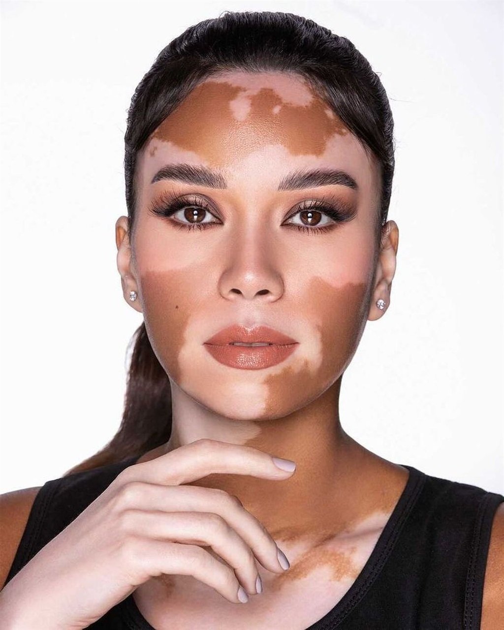Vitiligo,skin
