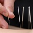 Mixed results for acupuncture for IBS