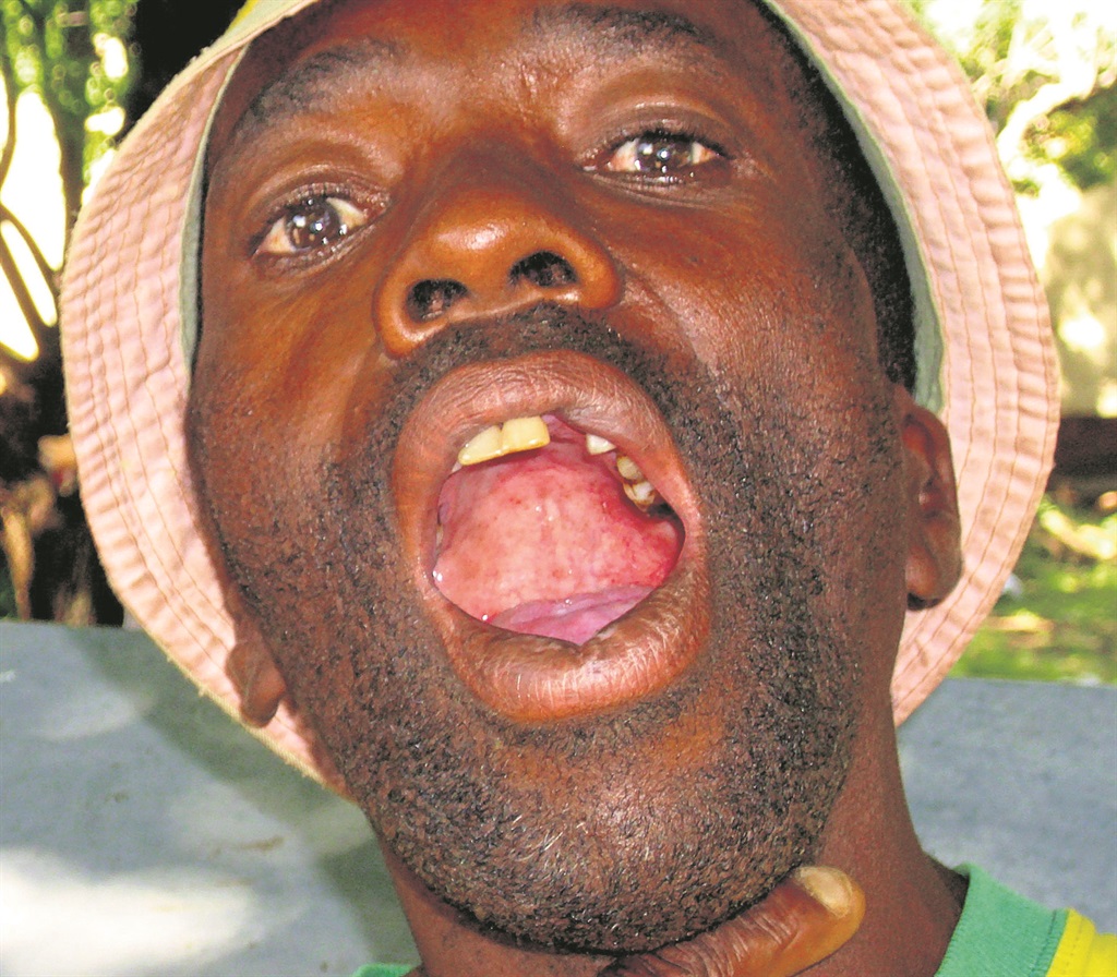 Shadrack Sesing says four of his teeth were knocked out by his boss.       Photo by Ezekiel Morake 