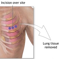 Pleural biopsy Life