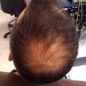 Coping with child hair loss | Life