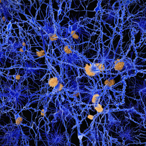 Alzheimer's disease neurons