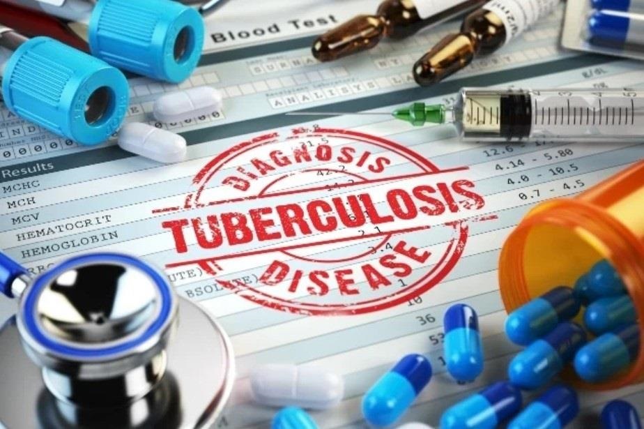 TB continues to be the leading cause of death in South Africa. Photo by Getty Images