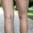 What are varicose veins?