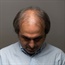 How is hair loss in men treated?