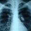 Blood protein might help early lung cancer detection