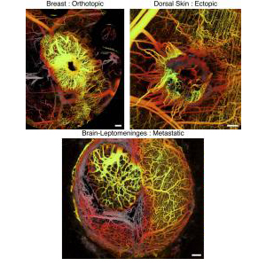 New imaging reveals strikingly different networks of blood vessels surrounding different types of tumors in a model. Left: breast cancer in the breast. Middle: metastatic breast cancer in the brain. Right: ectopic breast cancer