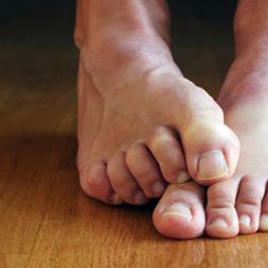 dry soles of feet