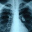 Breath test may reveal early-stage lung cancer