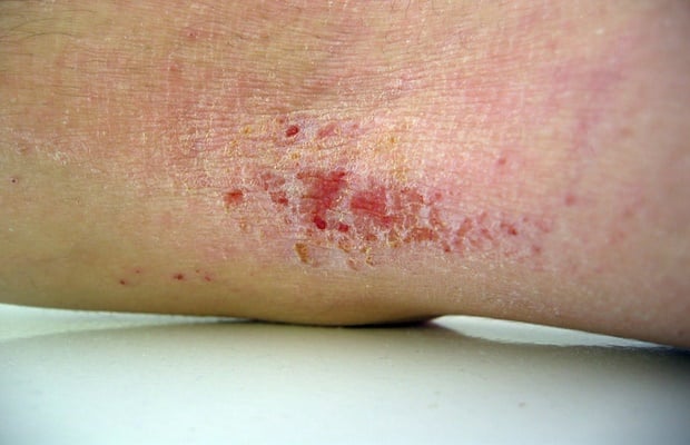 what does eczema on skin look like?
