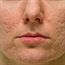 Acne scars: treatment options