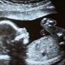 Illegal abortion horror continues