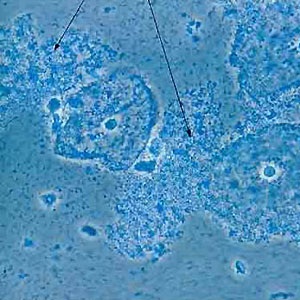 Micrograph of bacterial vaginosis — squamous cells of the cervix covered with rod-shaped bacteria, Gardnerella vaginalis (arrows).