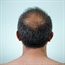 Triggers for hair loss