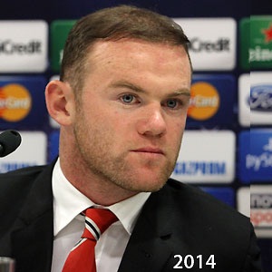 Wayne Rooney before and after  follicular transfer