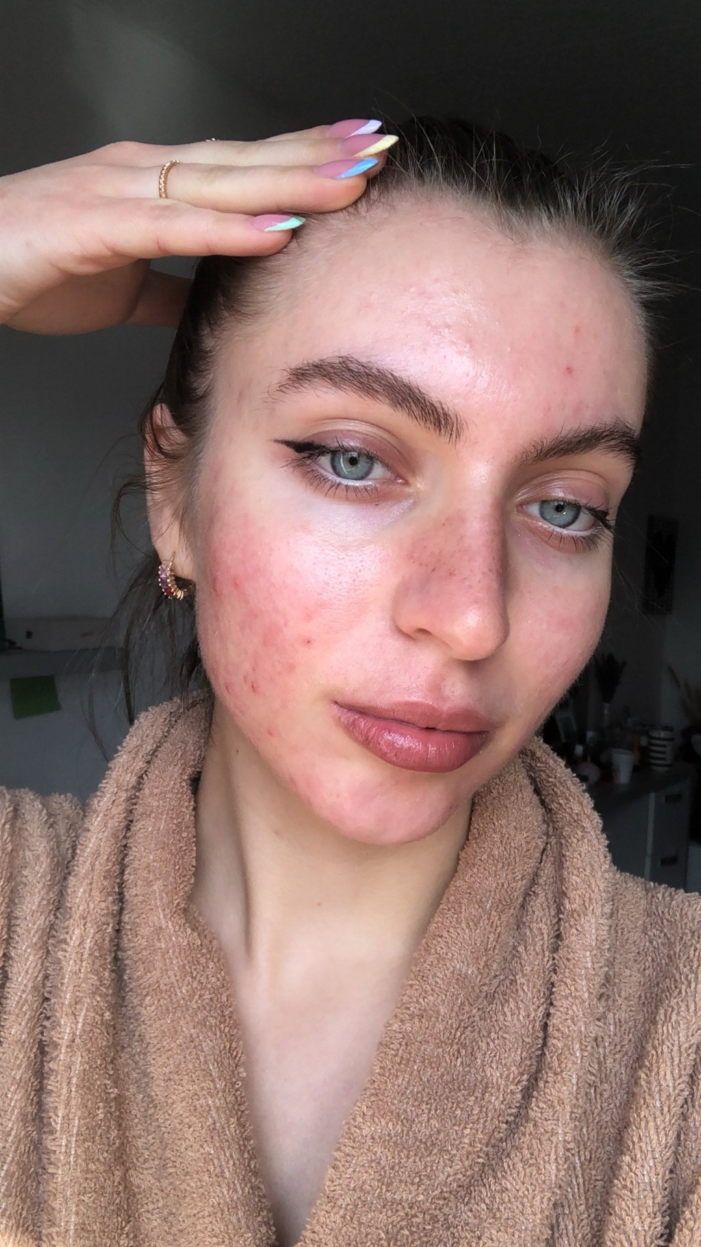 acne, dating, skin