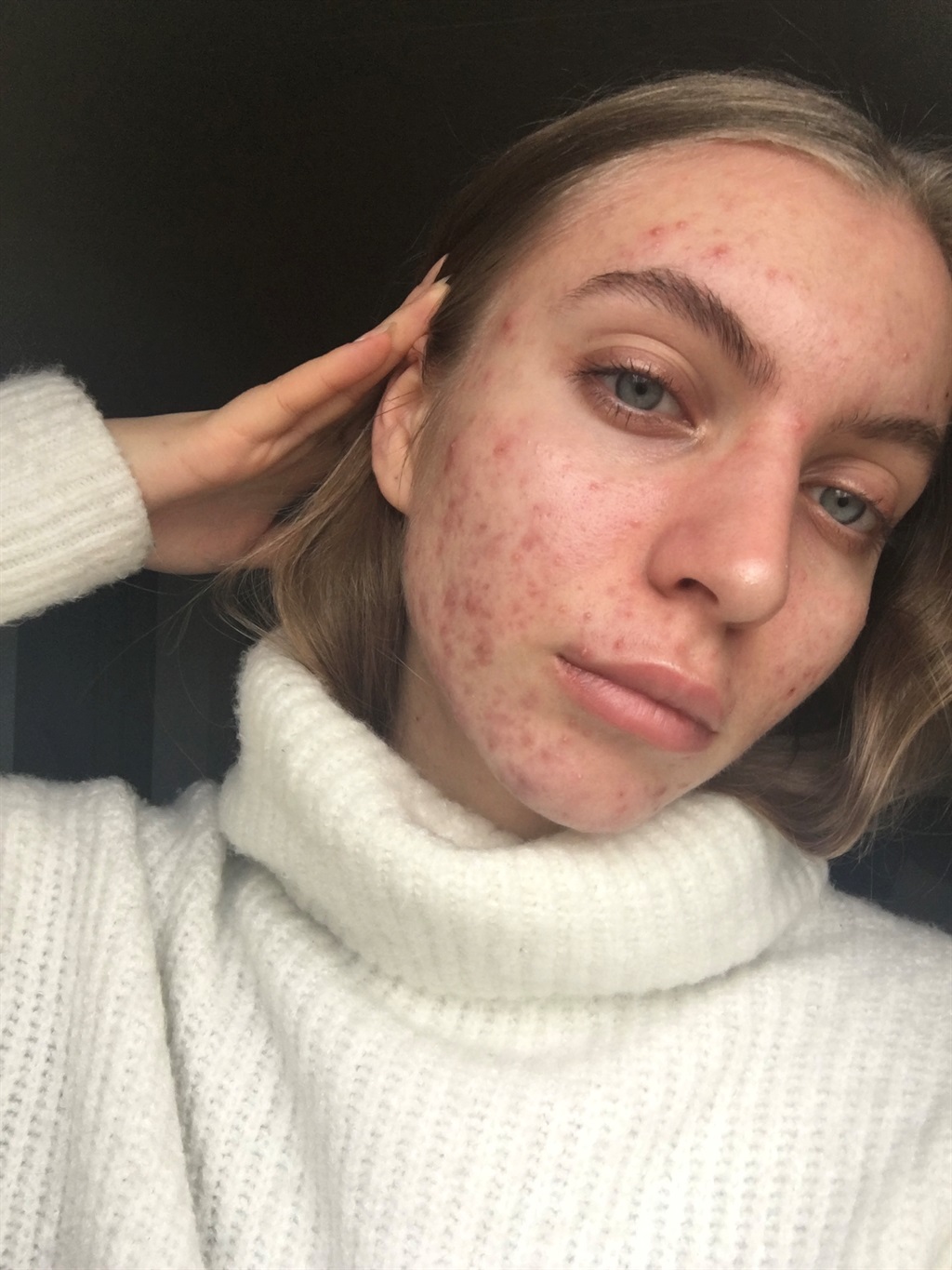 acne, dating, skin