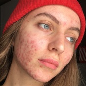 19-year-old shares how acne has affected her dating life and self-esteem