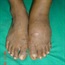 Charcot foot is often missed in diabetics 