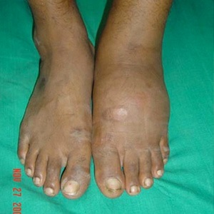 "Charcot arthropathy clinical examination" by J. Terrence Jose Jerome - Divergent Lisfranc’s Dislocation and Fracture in the Charcot Foot: A case report. Foot and Ankle Online Journal.