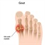 Causes of gout