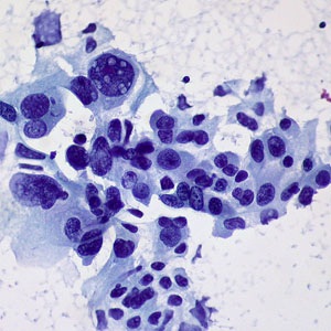 Non-small cell lung carcinoma from Flickr Creative Commons. 