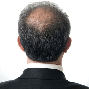 Arthritis and cancer drug may fight baldness Life