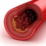 High cholesterol tied to prostate cancer recurrence