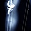 Knee replacement: animation