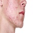 Prevalence and course of acne