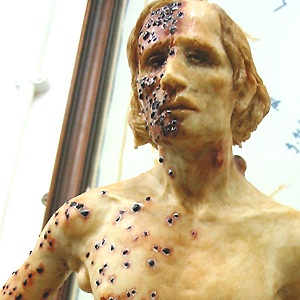 A Wax figure representing someone infected with bubonic plague. The figure was created by British medical artist Eleanor Crook.
