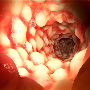 Intestine with Morbus Crohn from Shutterstock