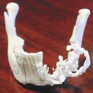 World's first 3D printed jaw transplant