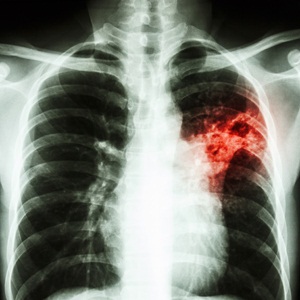 Chest x-ray from Shutterstock