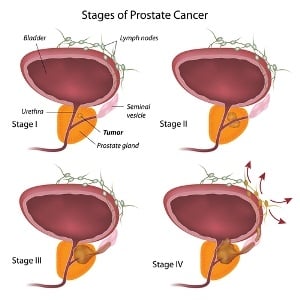 prostate cancer staging and grading)