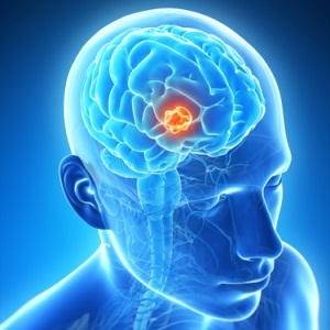 Brain tumour from Shutterstock