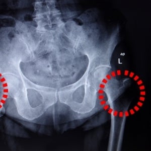 Pelvis with marked hip joint from Shutterstock
