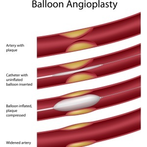 Balloon angioplasty by Shutterstock 
