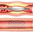 Stents are best for removing stroke-causing blood clots