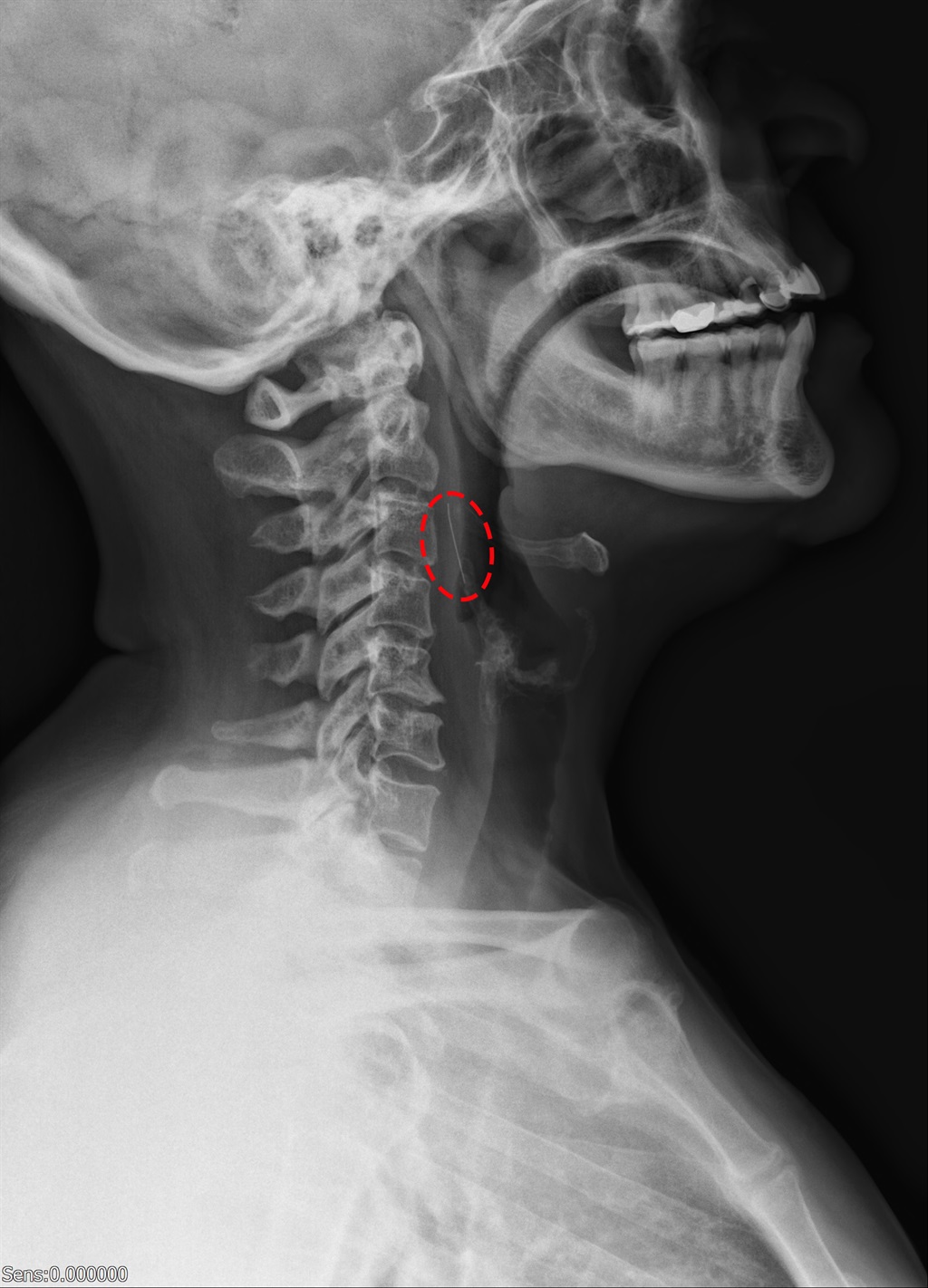 Op die X-strale kan ’n mens die voorwerp, van sowat 2 cm, in haar keel sien vassit. Foto: Verskaf