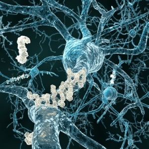 Alzheimer's disease from Shutterstock